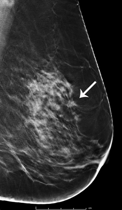 leesburg breast cancer mammogram images|3D Mammography .